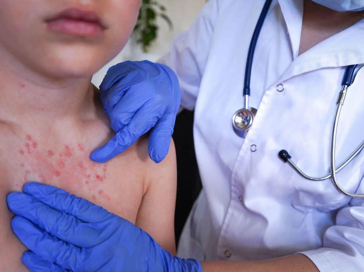 Desinformación antivacunas agrava la vulnerabilidad de Honduras frente al sarampión