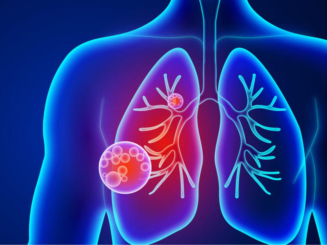 Así se desarrolla la neumonía bilateral, la enfermedad que sufre el papa Francisco