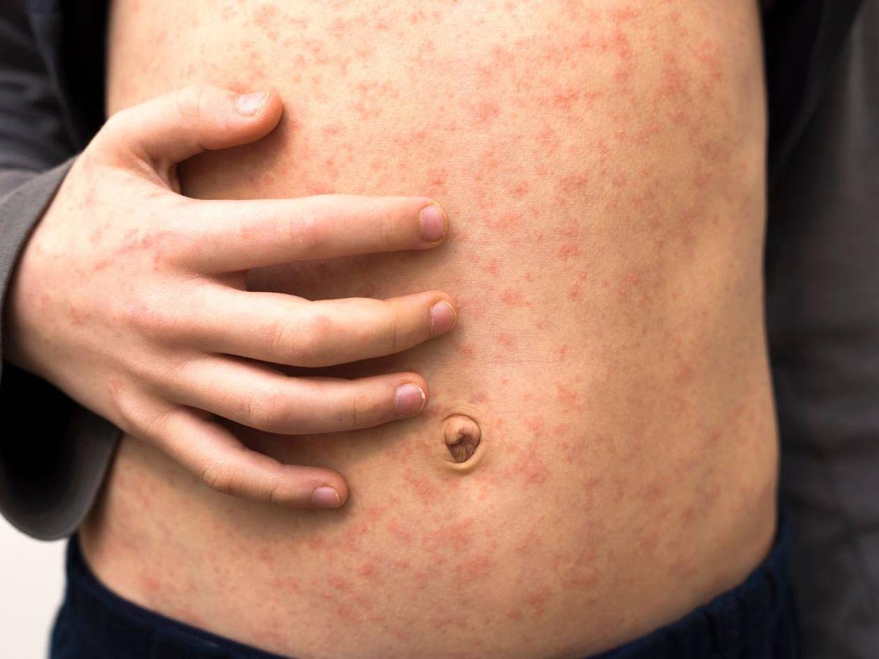 Alerta sanitaria en Honduras por sarampión; piden vacuna a viajeros