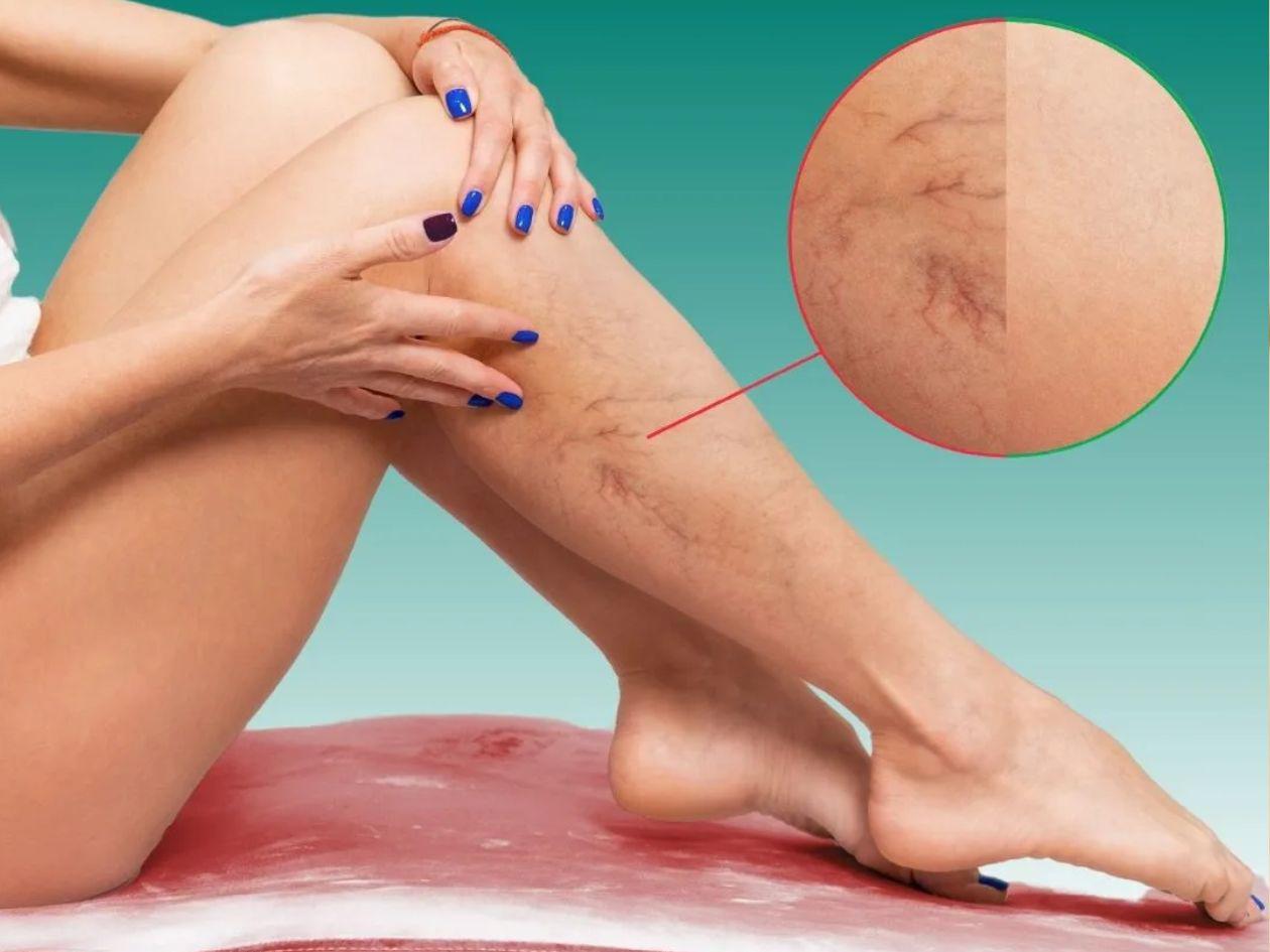 Trombosis: síntomas, prevención y tratamiento