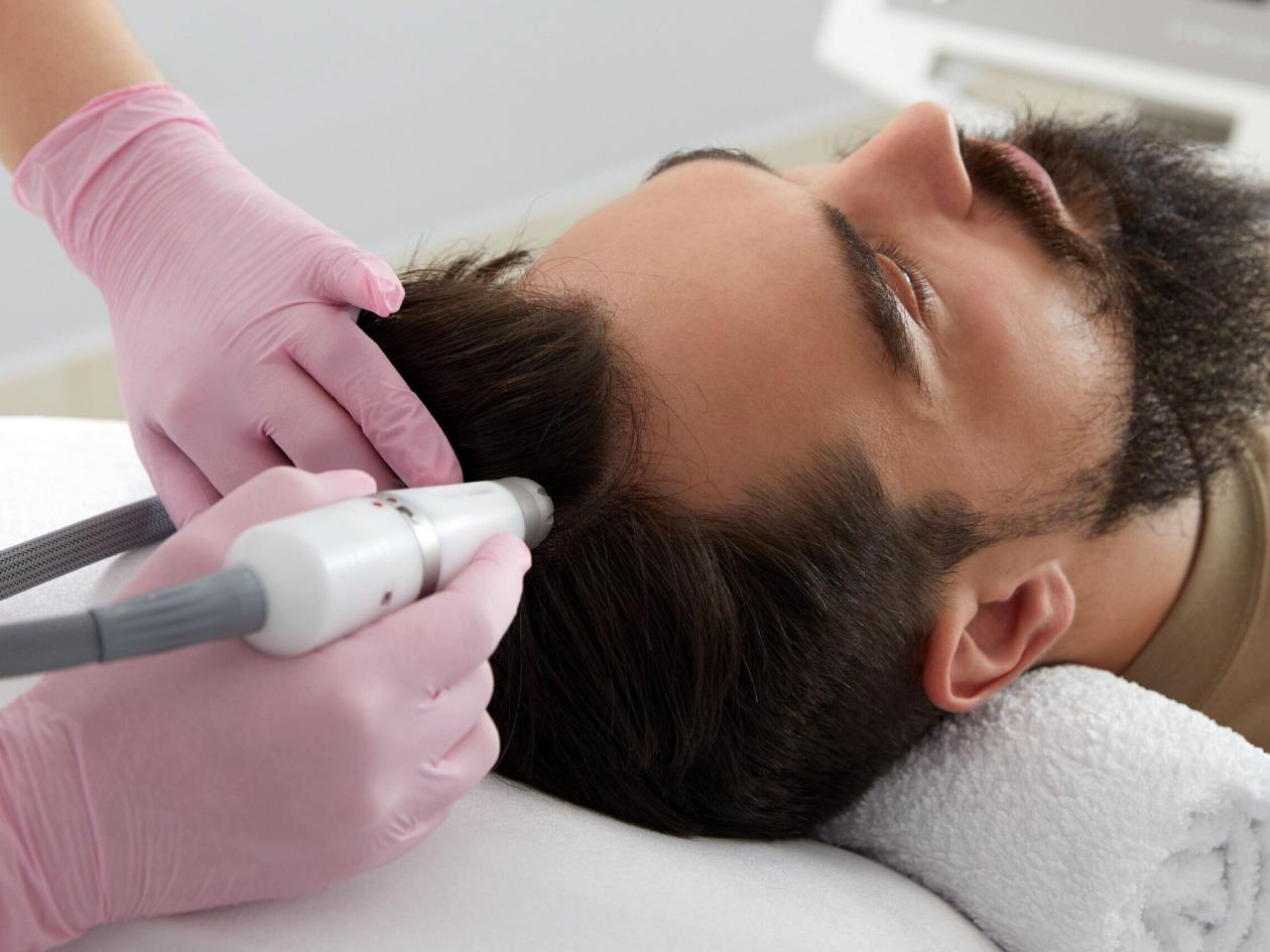 Más allá del implante capilar: tratamientos para la alopecia