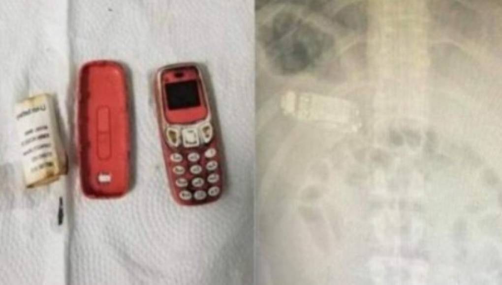 Equipo médico extrae un teléfono móvil del estómago de un preso