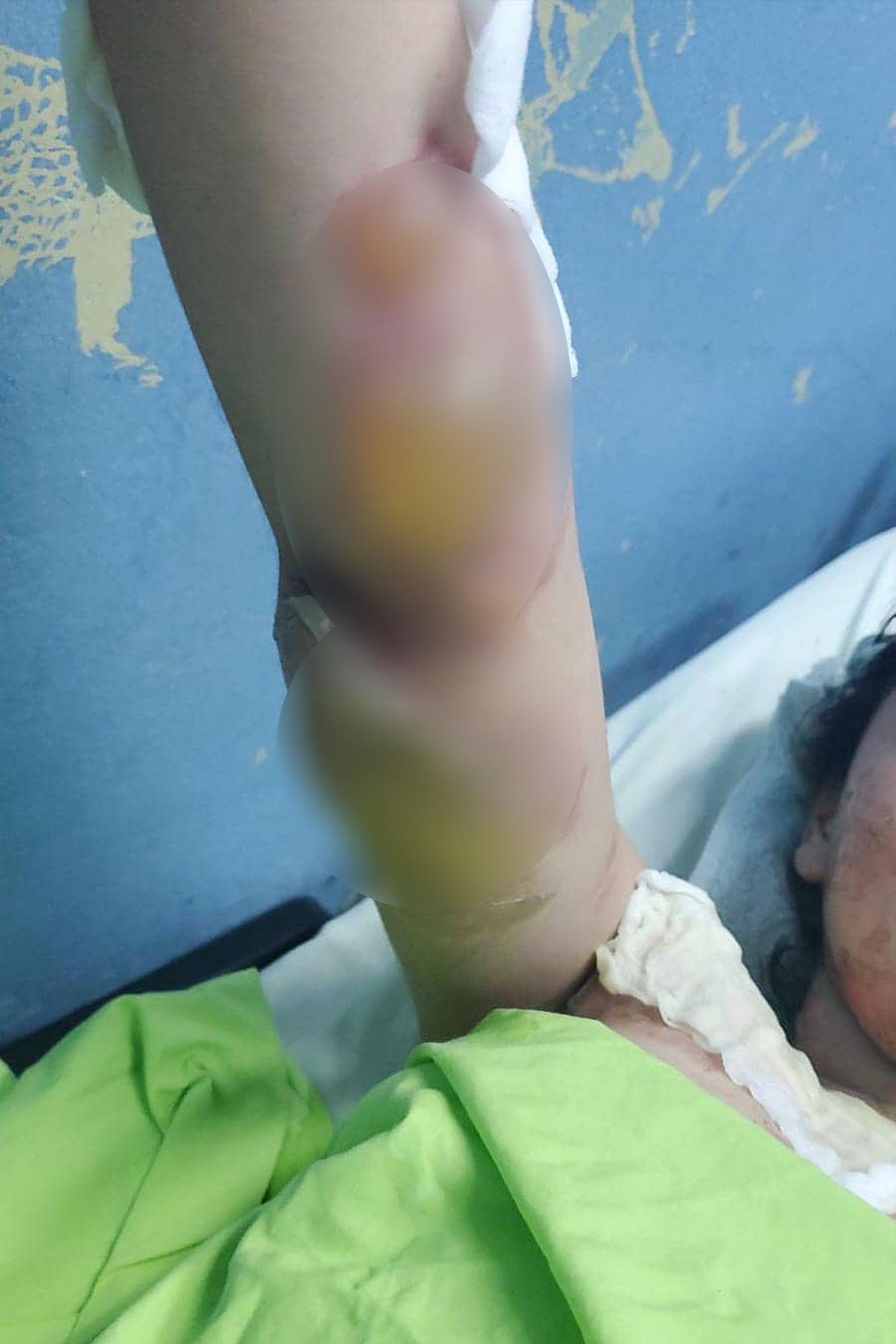 Los brazos de la pequeña fueron de los más afectados.