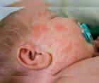 Un bebé con síntomas de sarampión recibe atención médica en una fotografía de referencia.