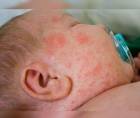 Un bebé con síntomas de sarampión recibe atención médica en una fotografía de referencia.