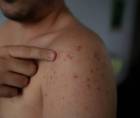 Autoridades sanitarias mantienen vigilancia epidemiológica intensificada ante la alerta regional, tras la confirmación de nuevos casos importados en el país.