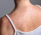 Salud llama a niños, adolescentes y adultos susceptibles a completar su esquema de vacunación para prevenir el sarampión.