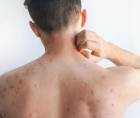 Las autoridades de salud insistieron en que la <b>vacunación</b> continúa siendo la medida más eficaz para prevenir contagios. Imagen referencial.