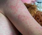 Las autoridades de <b>salud</b> reiteraron que la vacuna es la única medida eficaz para evitar muertes . Imagen de archivo.
