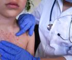 Un niño con síntomas de sarampión es atendido en un centro médico en una fotografía de referencia.