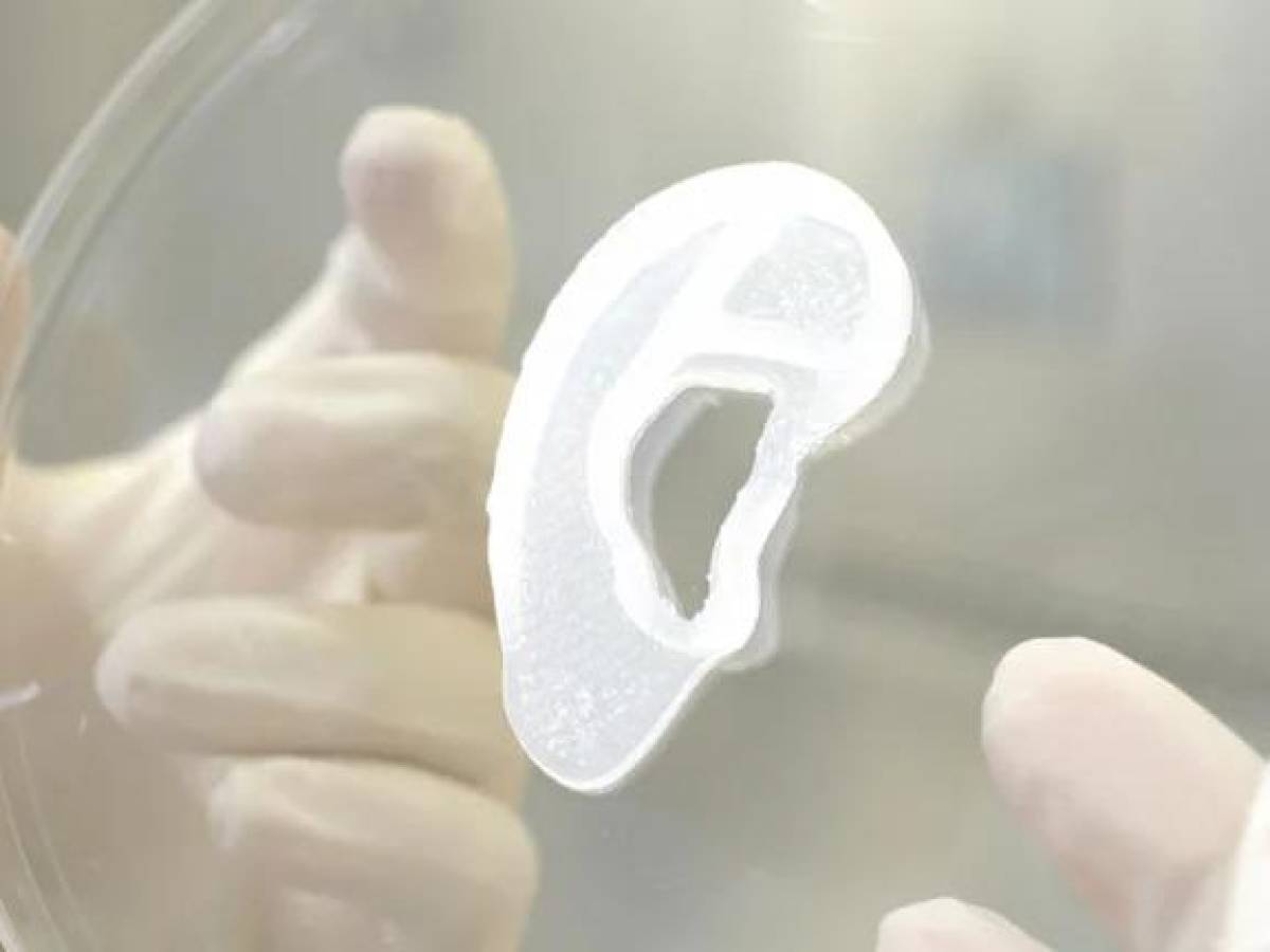 ¡Hazaña médica! Implantan en paciente una oreja impresa a partir de células humanas