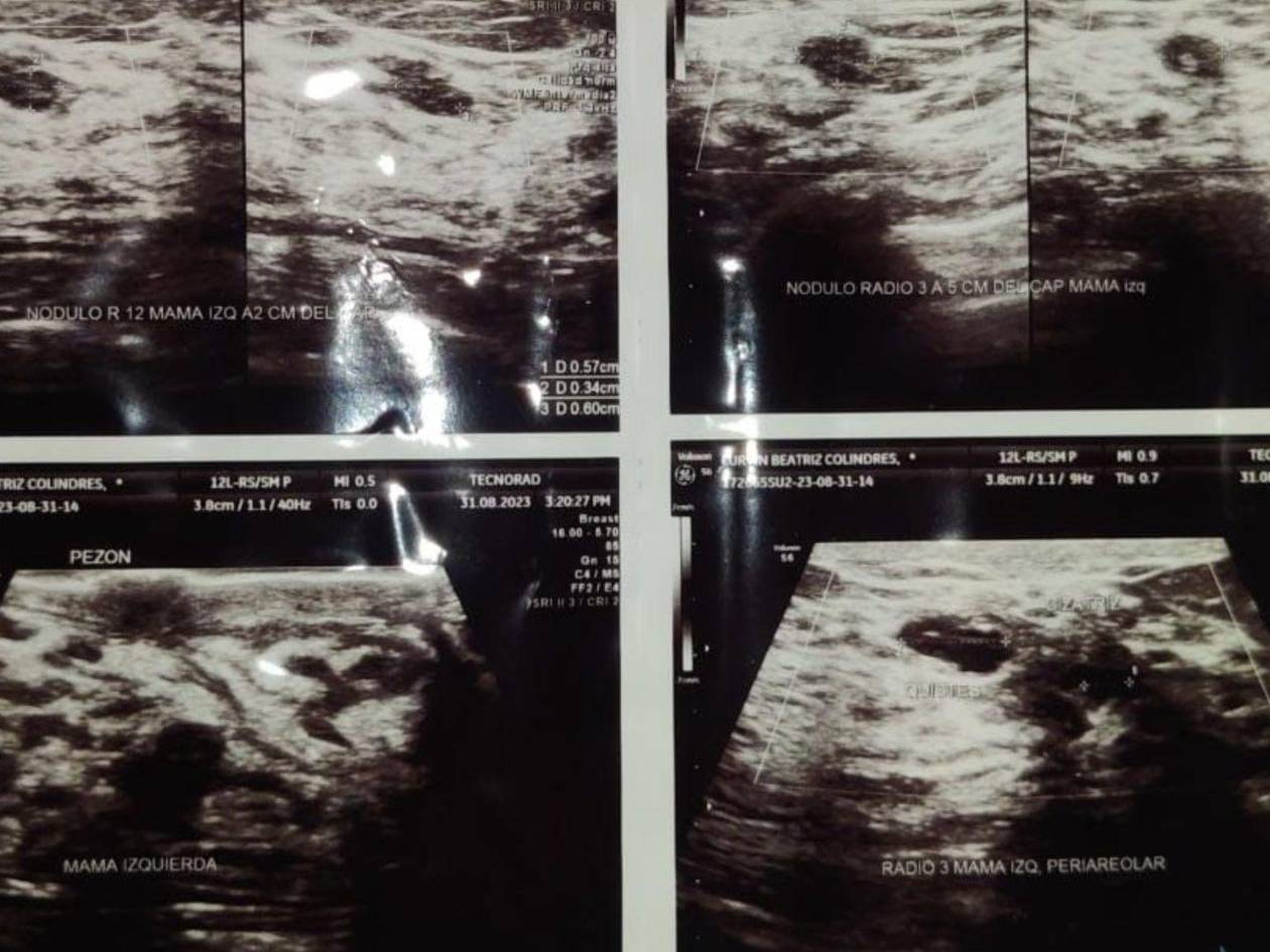 Ultrasonido que mostraba los resultados preliminares de la condición de una de las mamas de Lurvin Colindres.