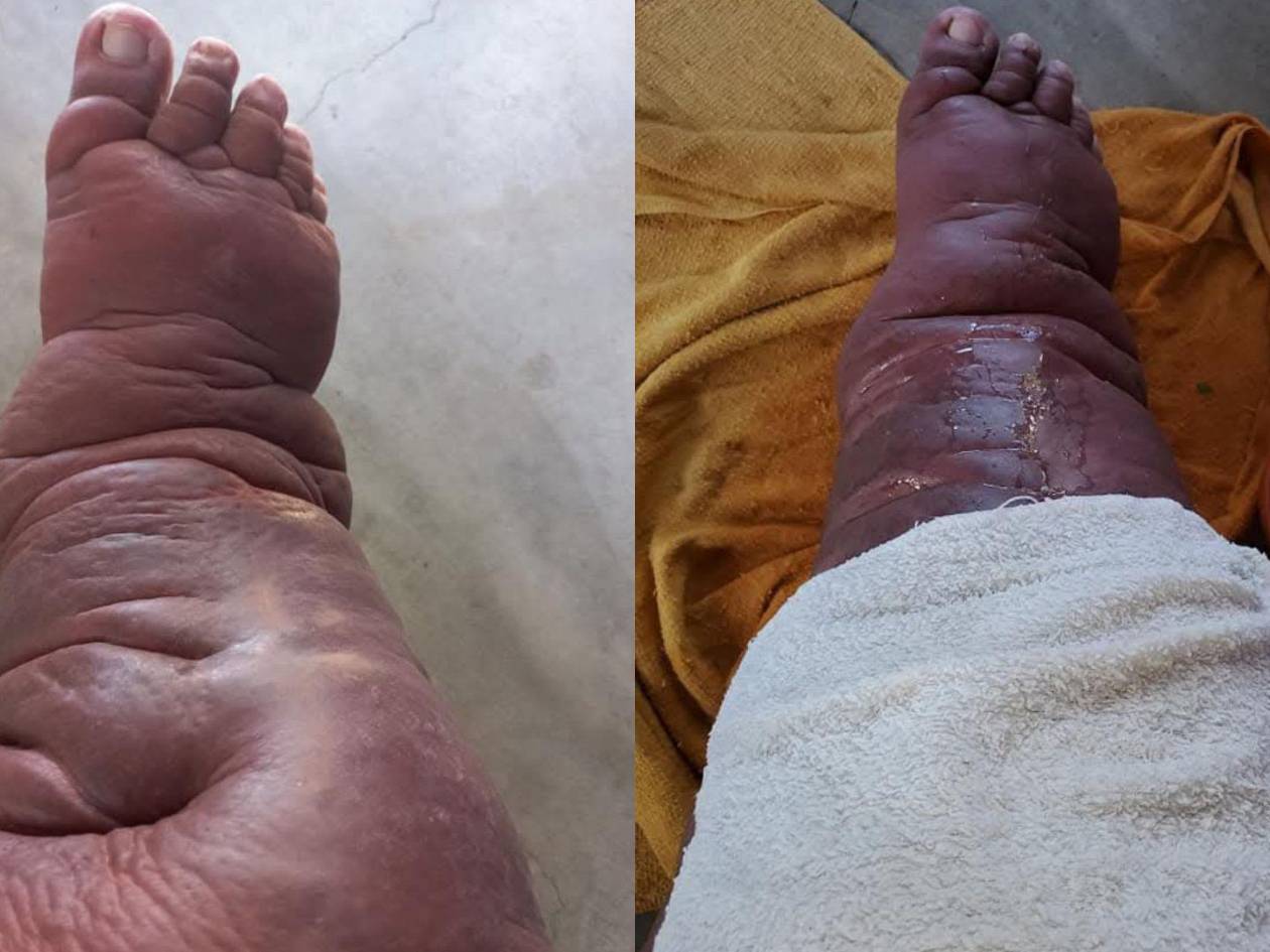 La elefantiasis genera un aumento desproporcionado de las extremidades, afectando la movilidad y la calidad de vida de los pacientes.