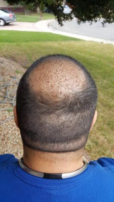 Trasplante capilar en Honduras: 9 cosas que debes saber