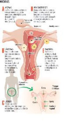 Miomas, un mal muy natural