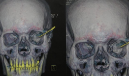 Sacan cuchillo de casi 9 centímetros del cráneo de un hombre