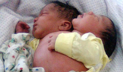 Nace un bebé con dos cabezas en Brasil