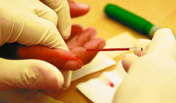 Aumenta incidencia de enfermedades de transmisión sexual en San Pedro Sula