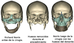 El trasplante de cara más completo de la historia