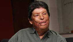 Irwin Sánchez, el hombre de las 80 cirugías y los 120 injertos