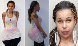 Falso doctor aumenta glúteos con cemento