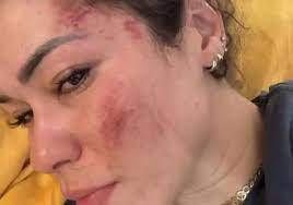 Fernanda mostró los golpes que recibió en todo el rostro e indicó que ademas fueron robados por los hombres que la asaltaron, si bien asegura: “teníamos muy poco, su verdadero motivo era violarme”.
