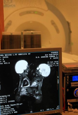 La resonancia magnética reveló cuales son los órganos que las niñas comparten.