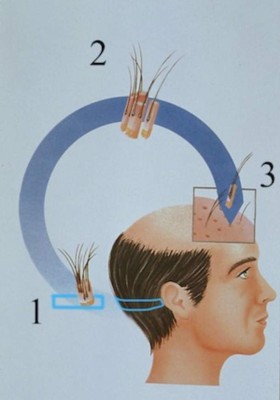 Trasplante capilar en Honduras: 9 cosas que debes saber