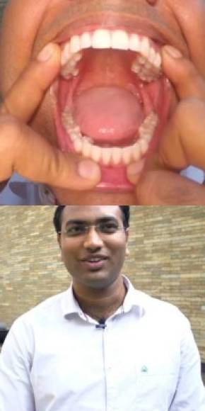 Más dientes en una boca:<br/><br/>Vijay Kumar V.A (India) tiene 37 dientes, como se verificó en Bangalore, India el 20 de septiembre de 2014.<br/><br/>Vijay tiene cinco dientes más que el promedio de adultos.<br/><br/>Este notó que tenía más 'poder mordaz' que la mayoría de la gente cuando era un adolescente.<br/>