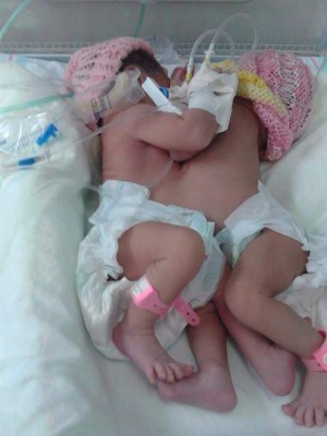 Siamesas nacidas en el Rivas comparten hígado y corazón