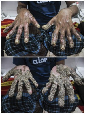 GRA008. DACCA, 24/08/2016.- Abul Bajandar, conocido como el 'hombre árbol' de Bangladesh, muestra sus nuevas manos tras someterse a una serie de operaciones después de que a los 15 años le detectaran epidermodisplasia verruciforme, una extraña enfermedad con la que había desarrollado pesadas verrugas con forma de corteza de árbol en manos y pies. Bajandar aún deberá afrontar un proceso de 'embellecimiento', con unas cinco intervenciones más que le mantendrán ingresado al menos durante 'los próximos seis meses', pero afirma sentirse 'genial' y que tener las manos libres 'es algo estupendo'. EFE/Igor G. Barbero