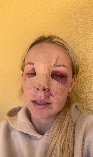 “Mi cara recibió el impacto, simplemente por la manera desafortunada en la que aterricé,” sigue explicando la joven de 19 años.