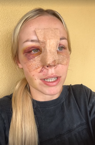 Asimismo, le mostró a sus seguidores cómo quedó su rostro y las fracturas faciales que le dejó el accidente: “Afortunada de estar viva”.