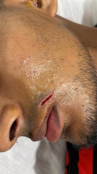 La herida en la parte superior del labio de Alejandro Raudales. El volante también tuvo que ser intervenido para cubrir y sanar la herida.