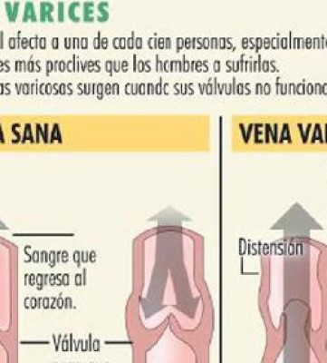 Las varices afectan más a la mujer blanca