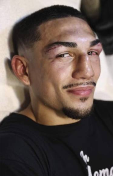 Así quedó el rostro del pugilista hondureño luego de la pelea con Lomachenko.