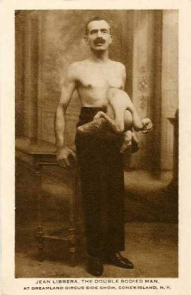 Jean Dia Libbera, también conocido como “El hombre de doble cuerpo” tenía un gemelo parásito unido a su área del pecho.