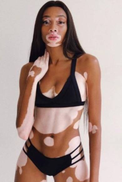 Winnie Harlow es la última adquisición de la popular marca femenina Victoria´s Secret, quien busca con Harlow reivindicarse al ser una franquicia que busca la perfección de la mujer. Winnie lucha por que su condición no dificulte su sueño de ser una top model. Conócela aquí: <br/><br/><br/><br/>