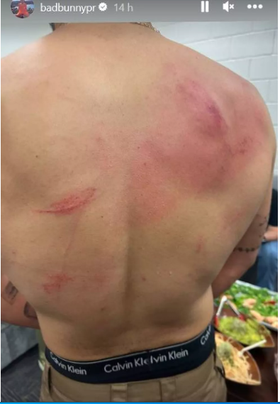 Bad Bunny compartió los resultados de la dura pelea en la WWE.