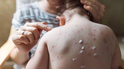 Un primer caso de viruela del mono se registró el jueves en Francia. Foto istockphoto