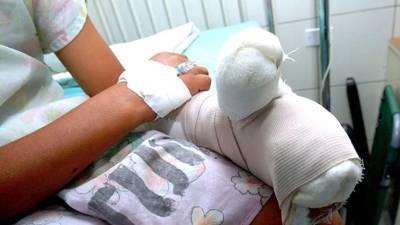 Fotografía de referecencia que muestra el brazo vendado de un niño por quemaduras.