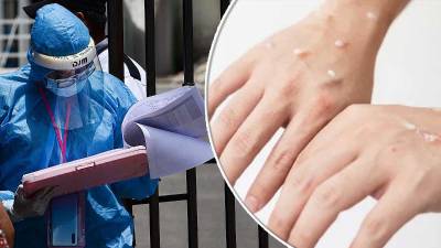 La tarde del viernes 12 de agosto de 2022 Honduras confirmó el primer caso de viruela del mono.