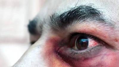 Honduras confirmó ayer tres nuevos casos.