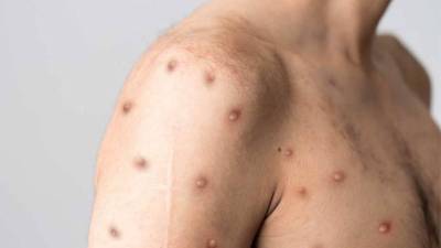 La noticia fue confirmada por el jefe de la Unidad de Vigilancia de la Salud, Lorenzo Pavón.