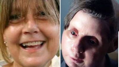 Charla Nash, una estadounidense, sufrió años atrás el terrible ataque de un chimpancé que le arrancó la cara y las manos. Hoy dice: 'Es muy difícil vivir así'.