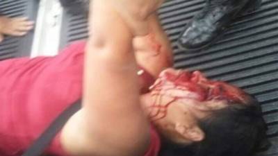 Eugenia Canales resultó con lesiones en el rostro tras ser herida con piedras y fue traslada al Hospital Escuela.