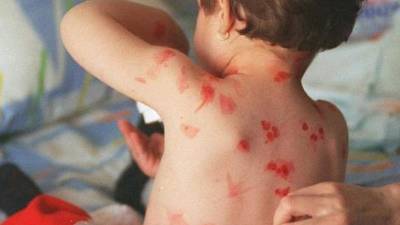 La varicela es una enfermedad viral altamente transmisible y se puede prevenir con la vacunación que está a nivel privado. Foto referencial.