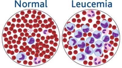 La leucemia es una enfermedad que afecta la sangre del pacientes.