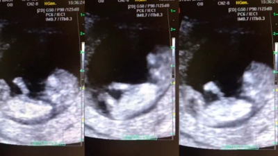 La impactante escena fue captada por una prueba de ultrasonido y el médico mexicano no dudó en compartirlo.