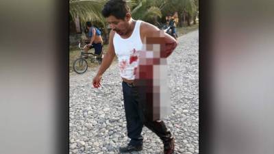 Marco Tulio Portillo cuando caminaba herido por las calles de Tocoa.